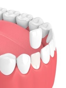 Procedimiento de Carillas Dentales