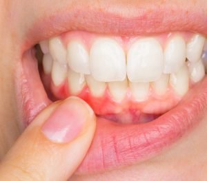 El sarro puede causar inflamación de las encías. Por eso es importante una profilaxis regular.