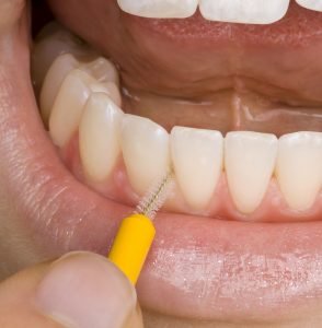 La acumulación de sarro es especialmente frecuente en los espacios entre los dientes. Puedes contrarrestarlo con cepillos interdentales e hilo dental.