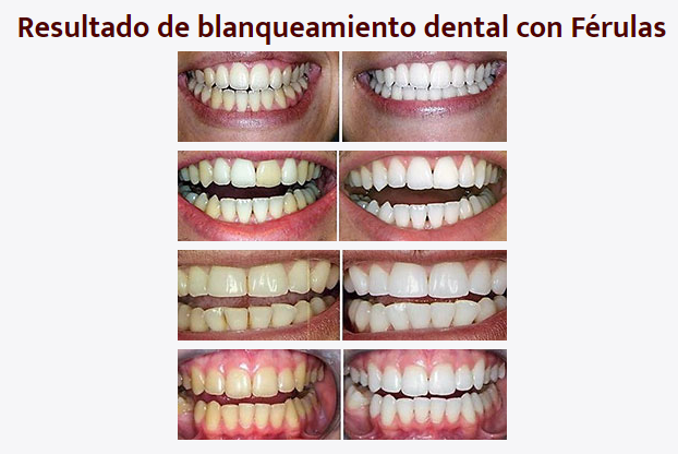 Precio de blanqueamiento dental en Rubí