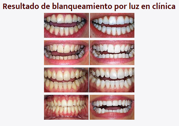 Precio de blanqueamiento dental en Albacete