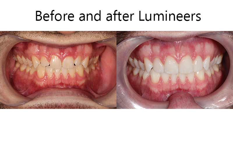 Before and After Lumineers 2