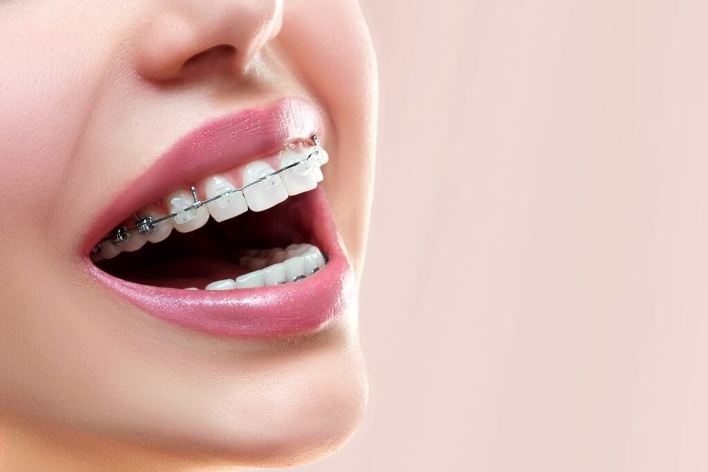 clear braces close up shot on a woman s teeth