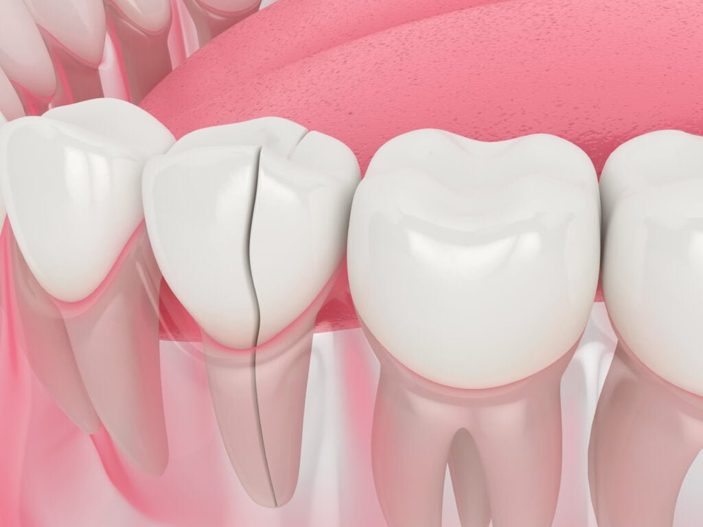 ¿Cuánto cuesta reparar un diente astillado?