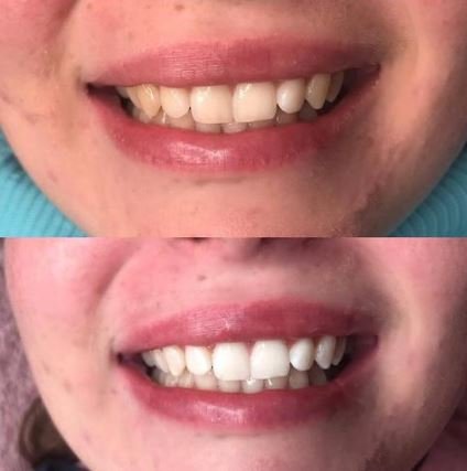 recensioni di sbiancamento dei denti con diamante sorriso