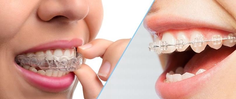 ¿Se pueden blanquear los dientes con brackets?