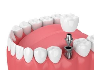 fallan los implantes dentales