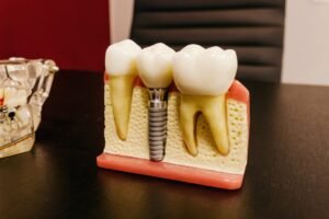 Implantes dentales de un solo diente (tipos y costos)