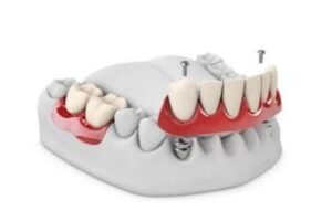 Dentaduras soportadas por implantes (pros, contras y costos)