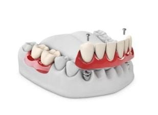 dentadoras soportadas por implantes