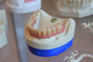 Dentaduras postizas híbridas (pros, contras y costos)