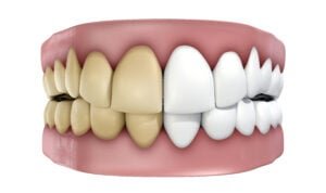 decoloración de los dientes