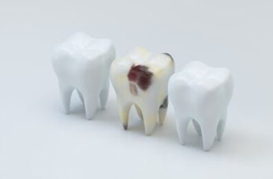 manchas marrones en los dientes