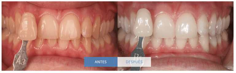 Precio de blanqueamiento dental en Vélez-Málaga