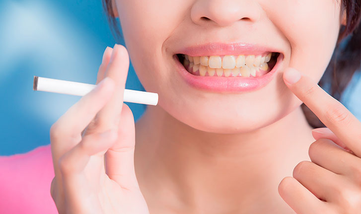 Blanqueamiento dental para fumadores
