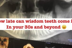 Understanding the Timeline of Wisdom Teeth Emergence