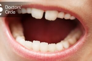 When Do Molars Typically Erupt?